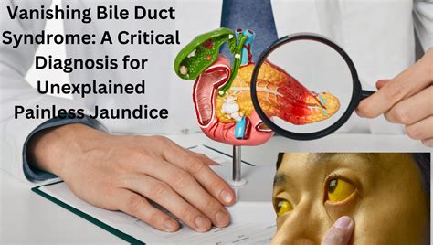 prd vbdrs|Vanishing Bile Duct Syndrome: Causes, Diagnosis, Treatment.